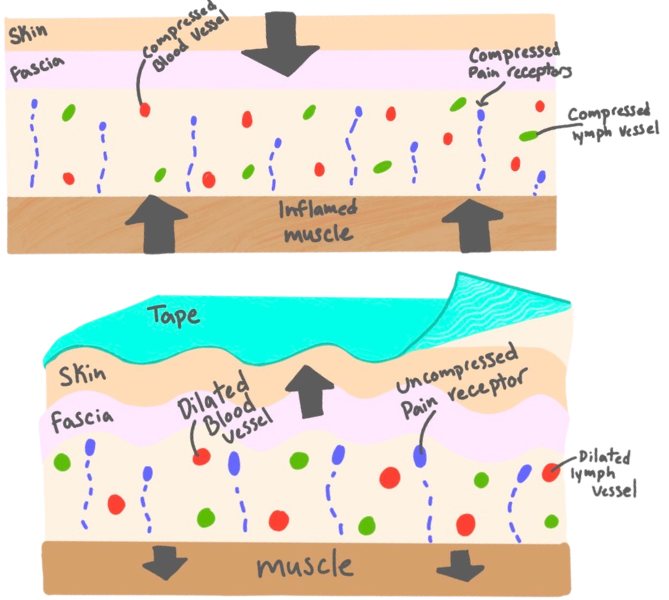 Diagram of skin, fascia, and muscle. Without tape, inflamed muscle compresses blood vessels, lymph vessels, and pain receptors. With tape lifting the skin, the layers decompress and the vessels and pain receptors open up.